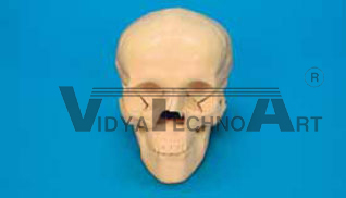 Skull, fractured, pre-mounted